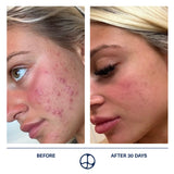 Before and after 30 days: a customer's cheek with red breakouts on the left and clearer skin on the right.