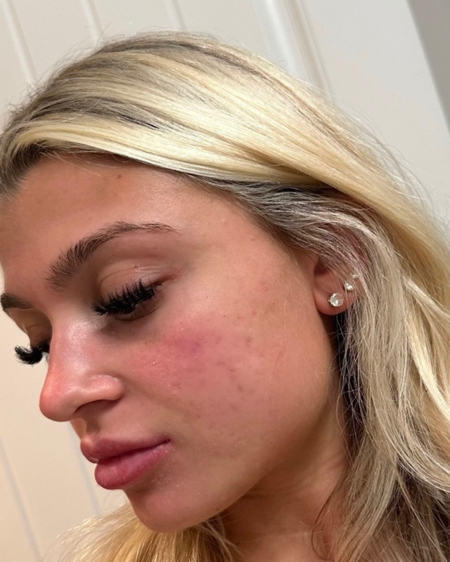 Skin At Peace skin transformation 1 — after