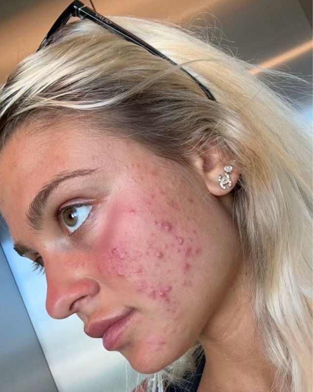 Skin At Peace skin transformation 1 — before