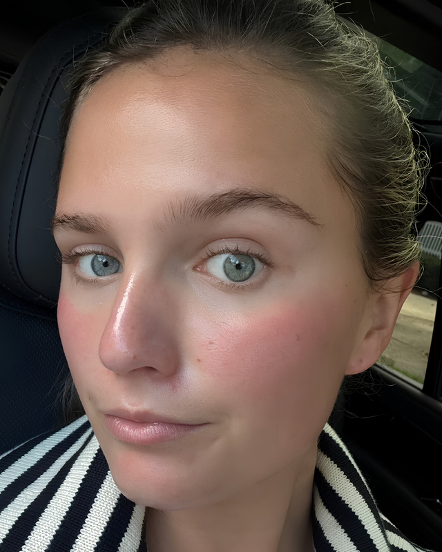 Skin At Peace skin transformation 2 — before