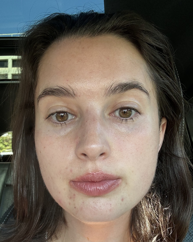 Skin At Peace skin transformation 3 — before