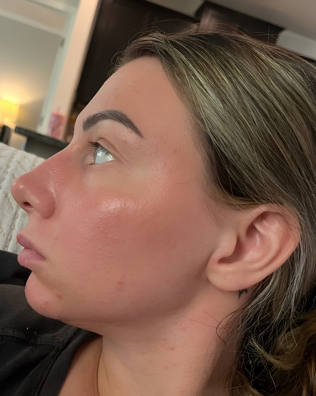 Skin At Peace skin transformation 4 — after