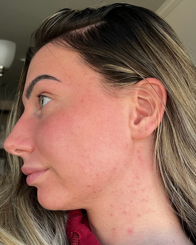 Skin At Peace skin transformation 4 — before