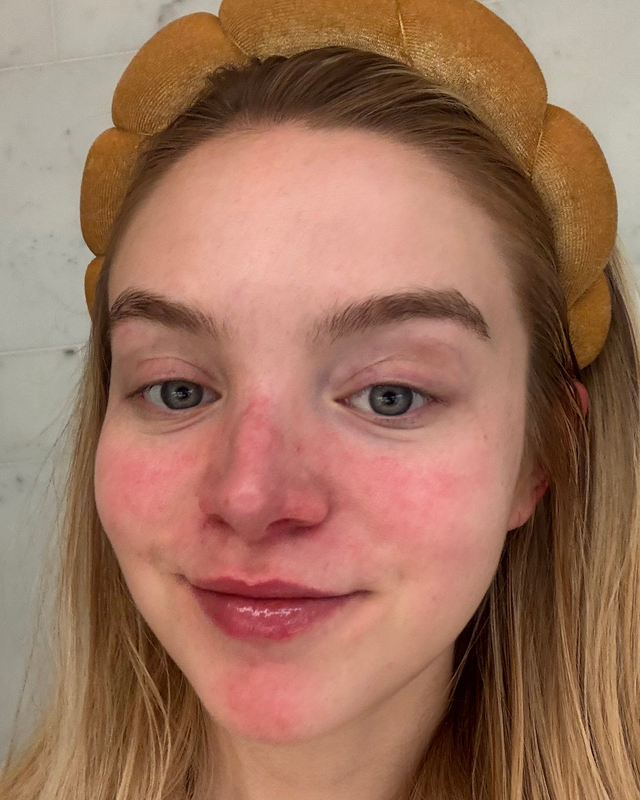 Skin At Peace skin transformation 5 — before