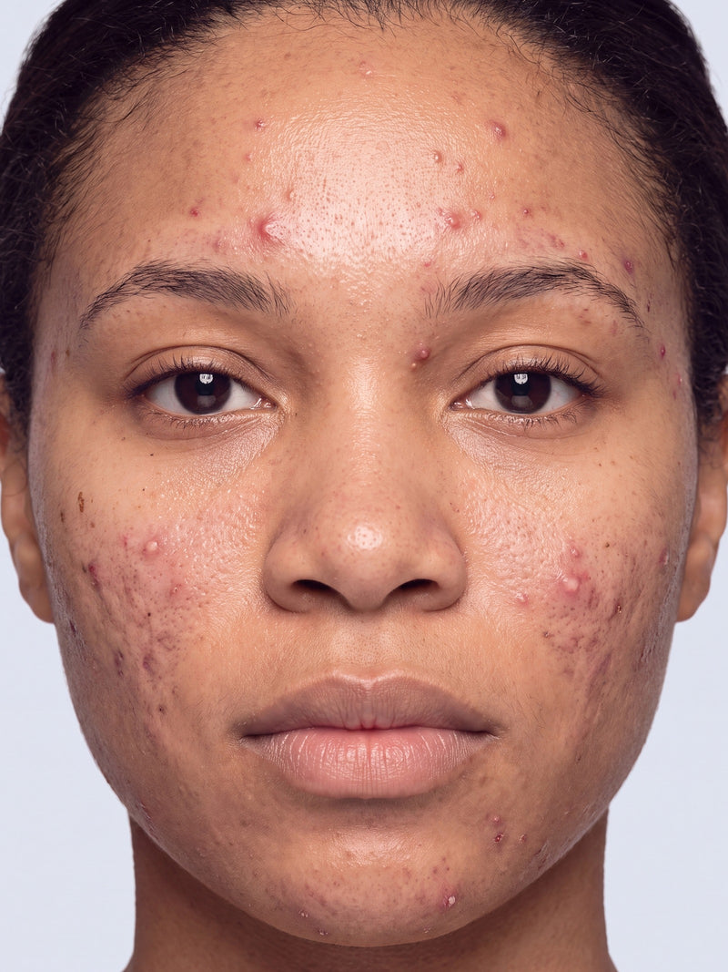 Severe / Cystic
