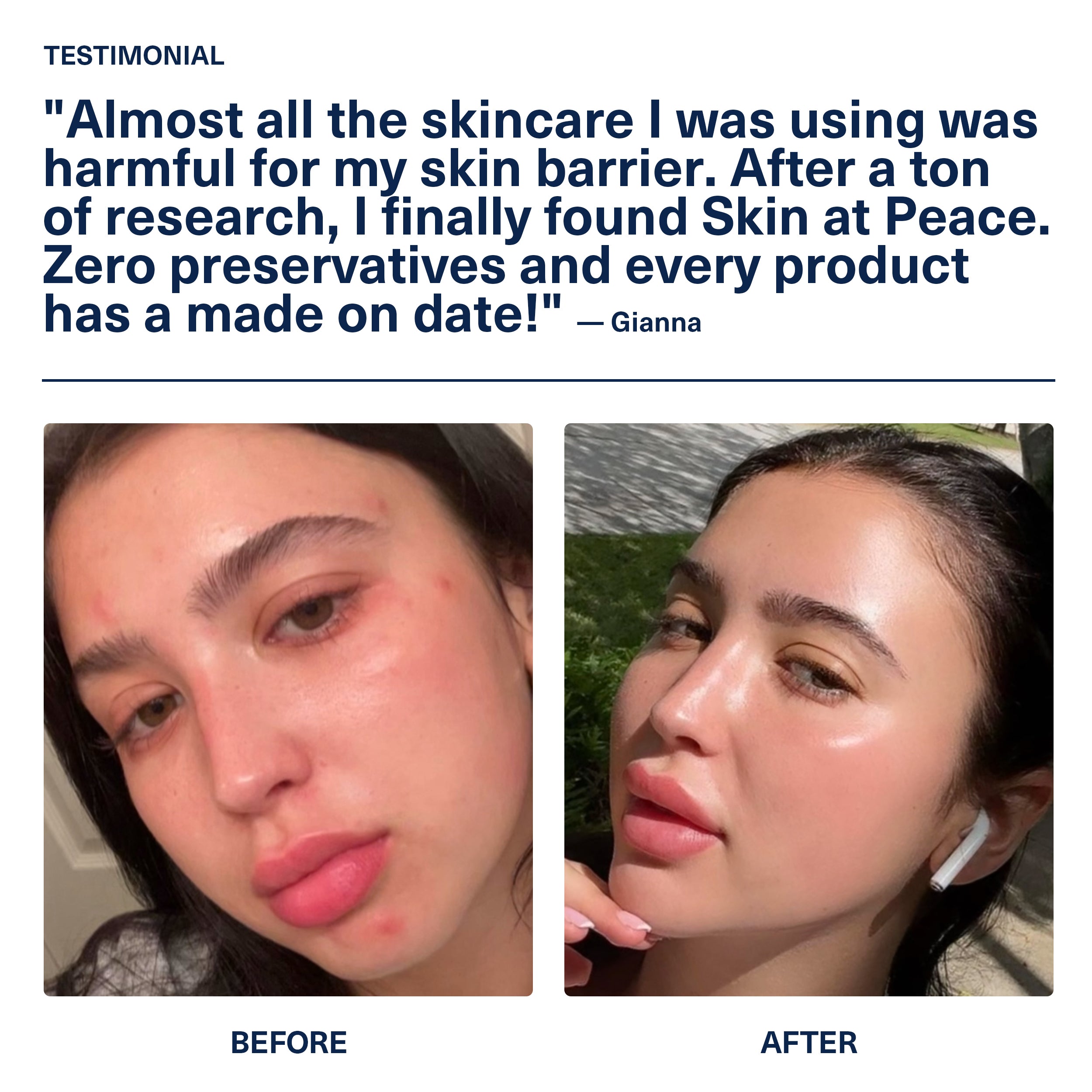 Customer testimonial from Gianna with a before-and-after: red, irritated skin on the left and clearer skin on the right.